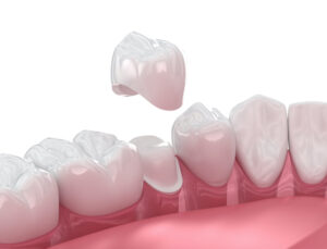 Knowing the right steps to take if a dental crown falls off can help prevent further damage and minimize discomfort.